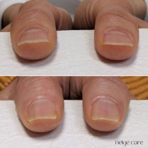 爪の悩み画像