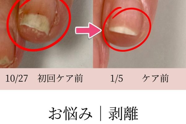 爪の剥離で悩まれていたお客様｜70日間・4回目の変化｜京都自爪育成サロン・ネージュケア