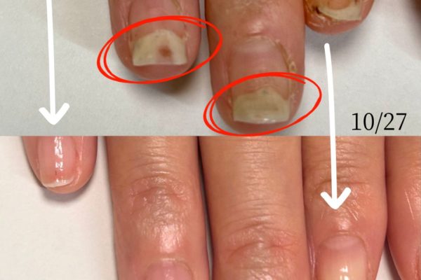 自爪育成サロンネージュケア｜2月のスケジュールと剥離ケアの経過について